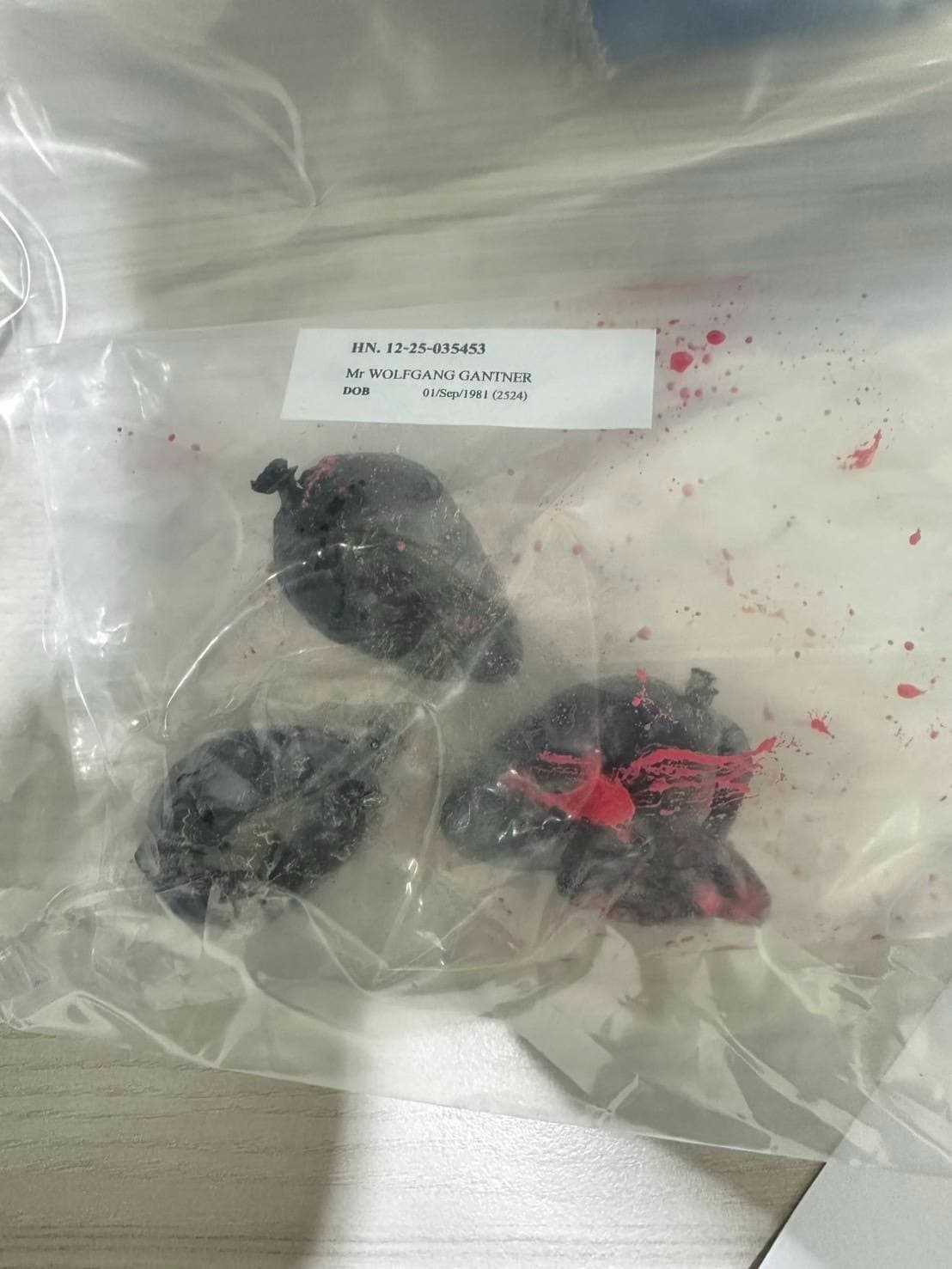 43歲奧地利籍男子甘特納體內取出3包毒品，其中1包已經破裂。（翻攝自สถานีตำรวจนครบาลหัวหมาก FB）