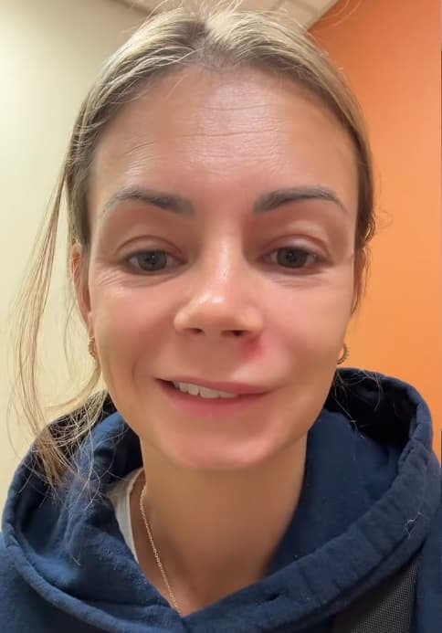 美國三寶媽因擠鼻下痘,4小時臉腫變形送急診,微笑時半邊臉無法動彈。(翻攝TikTok @lishmarie1)